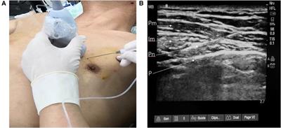 Preemptive parasternal intercostal nerve block for patients undergoing off-pump coronary artery bypass grafting: a double-blind, randomized, controlled trial